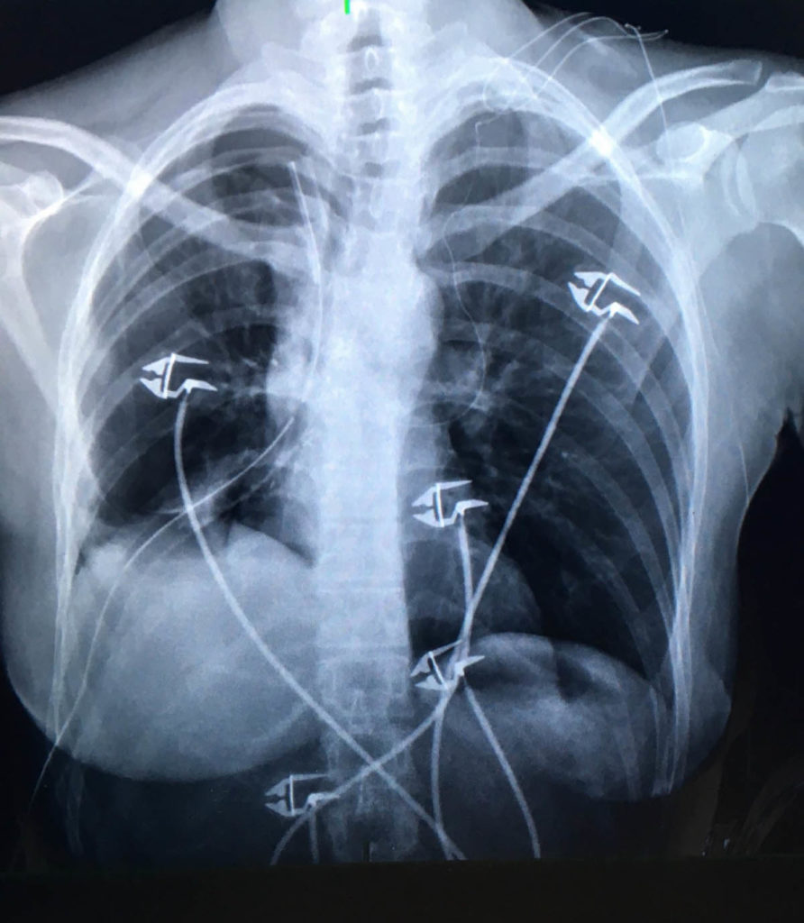 X-ray of a ribcage